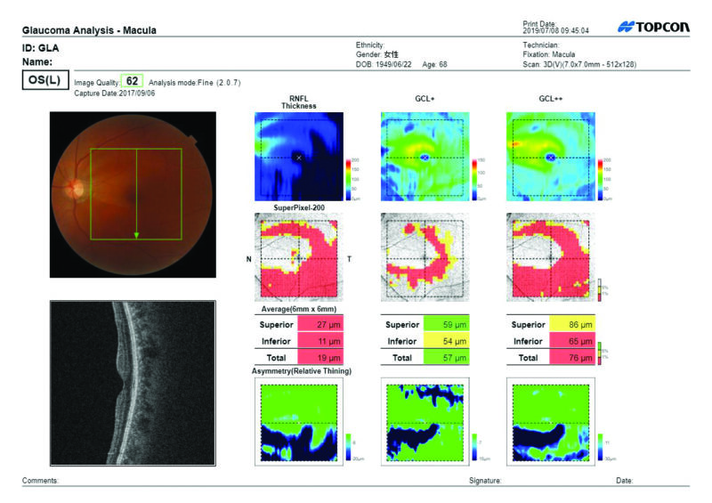 3D MacuLa gla report