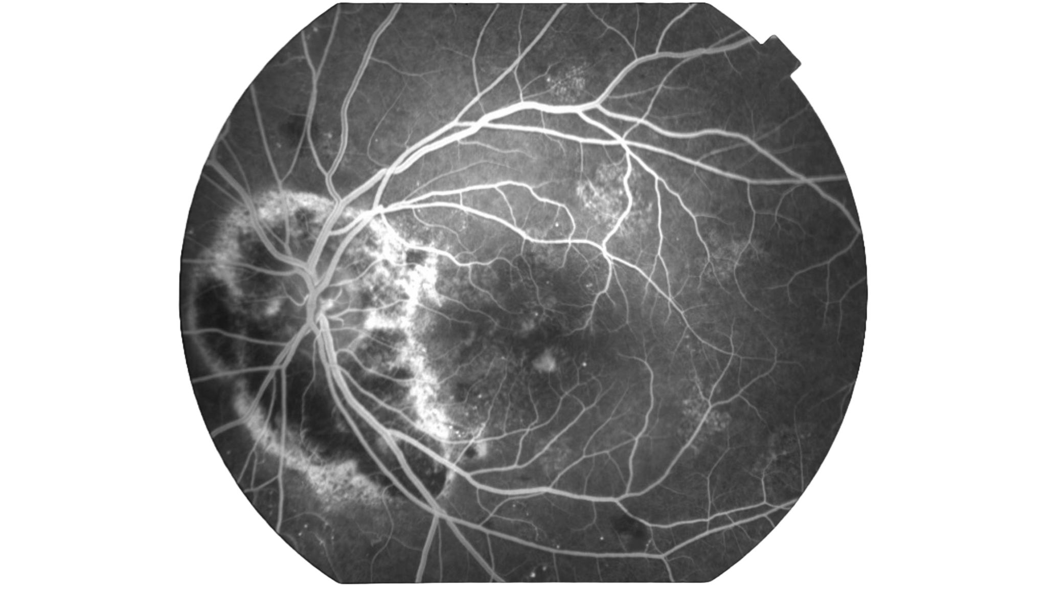 Tecnis PureSee Toric II DET - De Ceunynck Ophthalmology