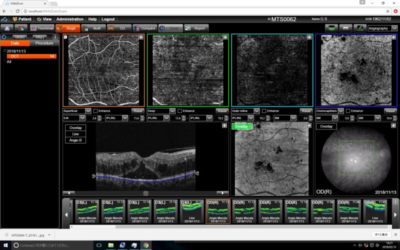 Topcon 3D OCT-1Maestro 2 OCTA screen