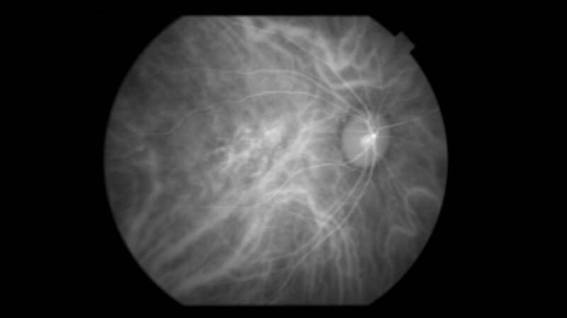 60 to 70 female with IOL_ICG_basler_OD